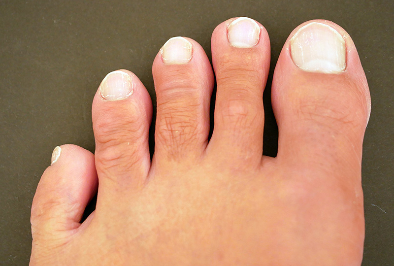 小指 違和感 の 足 足の指先に痛みやしびれなどの違和感を感じる原因と対処法