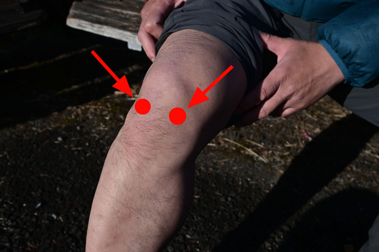 膝 横 の 腫れ